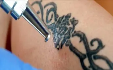 چگونه از شر تتوهای روی بدن خلاص شویم؟