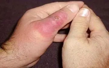 عقرب‌گزیدگی در کمین مردم رودبار جنوب