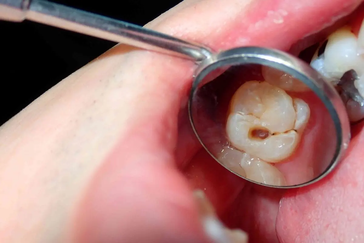 مهمترین عامل جلوگیری کننده از پوسیدگی دندان چه چیزی است؟