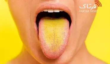 زردی زبان؛ از تغییرات بی‌خطر تا نشانه‌های بیماری‌های خطرناک