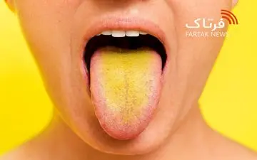 زردی زبان؛ از تغییرات بی‌خطر تا نشانه‌های بیماری‌های خطرناک
