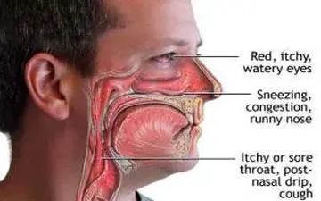 همه چیز راجع به پولیپ بینی