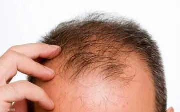 آقایان احتیاط کنید: این نوشیدنی‌ها باعث ریزش مو در مردان می‌شوند
