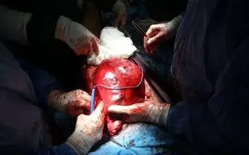 ۹۰ درصد توده های سرطان غده تیروئید خوش خیم هستند