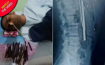 خارج کردن فلزات خطرناک از شکم جوان هندی!