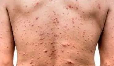 هشدار | خطرات بیماری آبله‌مرغان در بزرگسالی 