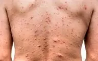 هشدار | خطرات بیماری آبله‌مرغان در بزرگسالی 