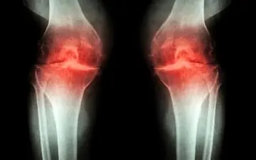 کشف درمانی جدید برای آرتروز