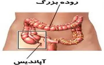  ۶راهکار ساده طب سنتی برای پیشگیری از آپاندیس