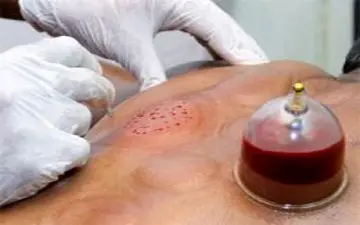 اثربخشی حجامت 