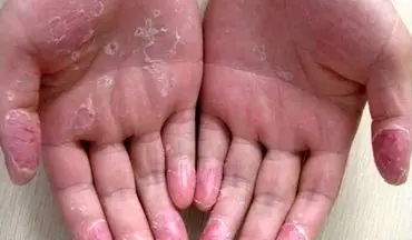 چه عواملی باعث پوست پوست شدن دست‌ها می‌شوند؟