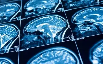 حجم مغز افراد روان‌آزار کمتر است