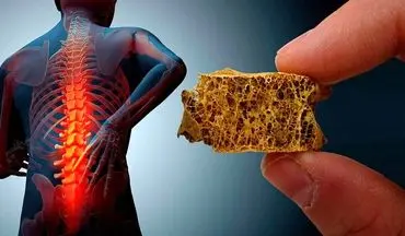 پایان پوکی استخوان؟ دانشمندان کلید ترمیم استخوان را پیدا کردند