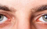  علت خشکی چشم چیست؟ + راهکارهای درمان آن