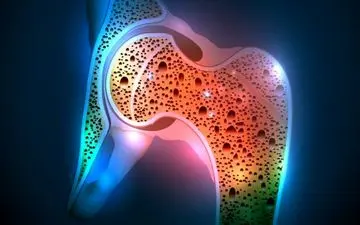 تاثیر دوز مصرفی داروی استاتین بر ریسک ابتلا به پوکی استخوان