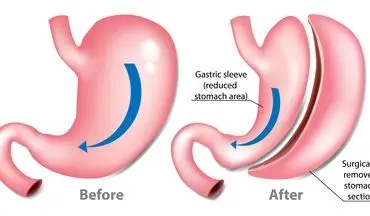 جراحی اسلیو معده چه کمکی به بیماران دیابتی میکند؟