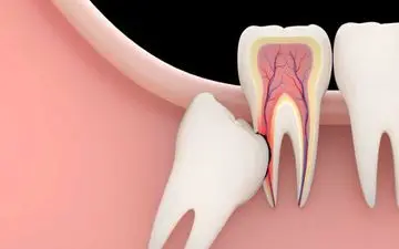 درمان دندان نهفته!
