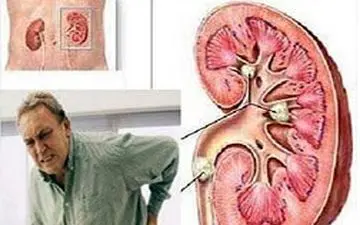 درمان های اصلی سنگ کلیه