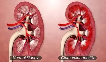 سندرم نفروتیک را بهتر بشناسیم