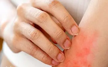 هنگام خارش ناشی از اگزما چه باید کرد؟