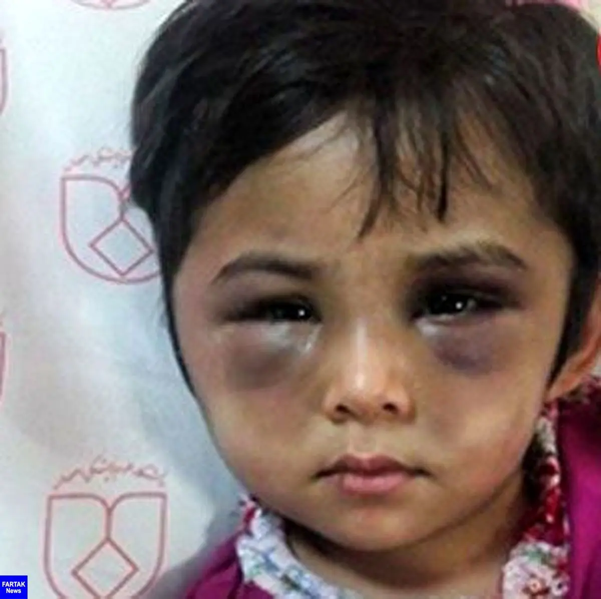  چهره کبود شده دختر اصفهانی / این ماجرا اشک همه را در می آورد