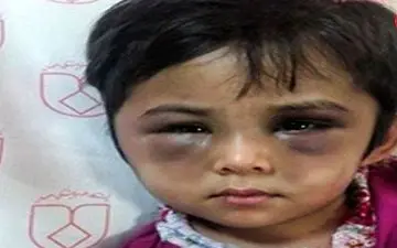  چهره کبود شده دختر اصفهانی / این ماجرا اشک همه را در می آورد