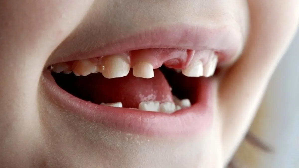 مراقبت از دندان های شیری، چرا و به چه علت