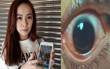 عجیب اما واقعی / پخته شدن چشم دختر جوان با نور موبایل + عکس