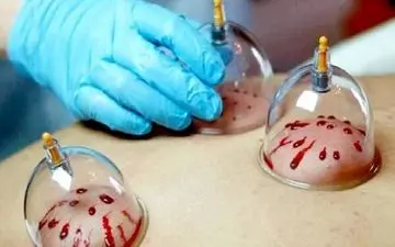  این افراد اجازه حجامت دارند