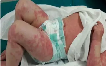 بیماری کاوازاکی در کودکان چه علائمی دارد؟

