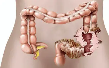 دیورتیکولیت یا التهاب دیورتیکولوم‌های روده بزرگ چیست؟