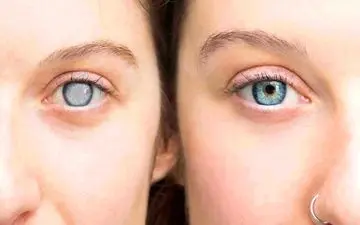  گلوکوم چیست؟ + راهکارهای درمانی آن