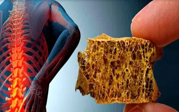 ۳ علامت اولیه شروع پوکی استخوان

