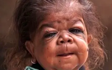 بیماری نادر این جوان 23 ساله، او را شبیه کودک یک ساله کرده است +عکس