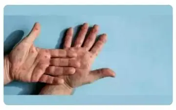 نظری کارشناسی درباره شیوع «آبله میمونی»

