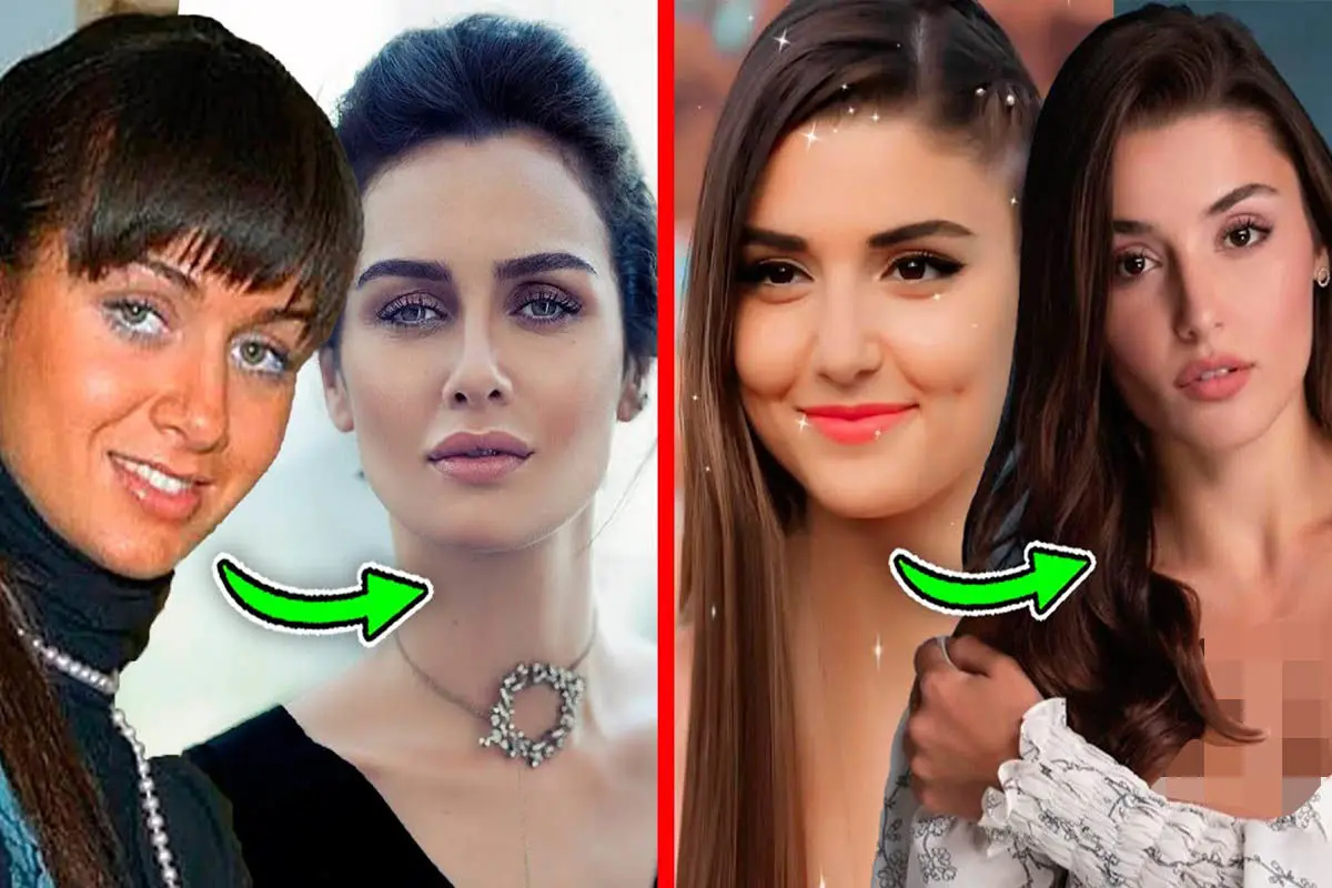 بازیگران زن ترک قبل و بعد از عمل‌های زیبایی | عملکرد شگفت‌انگیز جراحان زیبایی!