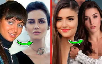 بازیگران زن ترک قبل و بعد از عمل‌های زیبایی | عملکرد شگفت‌انگیز جراحان زیبایی!
