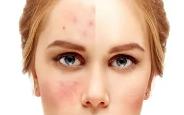 رمزگشایی از جوش‌های پیشانی: 3 راهکار ساده برای پیشگیری و درمان