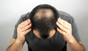 علت ریزش مو با افزایش سن چیست؟
