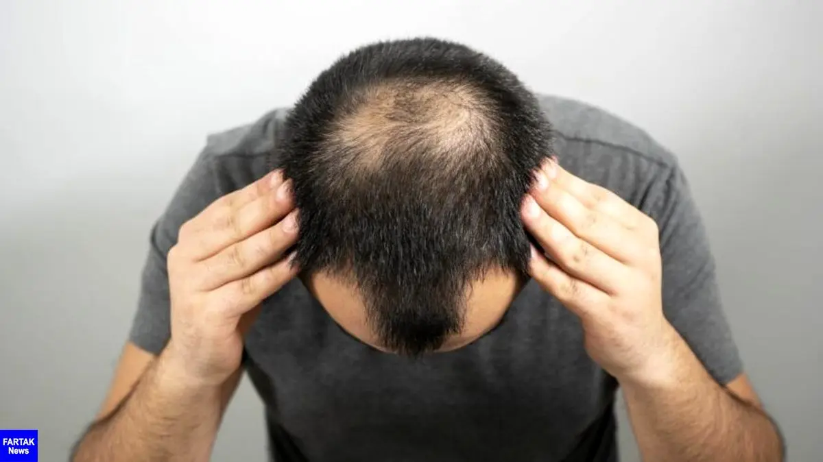 علت ریزش مو با افزایش سن چیست؟