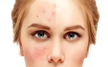 برای اینکه تابستون جوش نزنیم چیکار کنیم؟ | جلوگیری از جوش زدن در گرما + راه های درمان