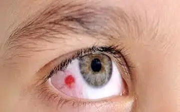  کرونای چشمی را جدی بگیرید