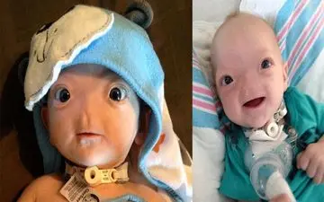 پسری که بدون بینی متولد شد +عکس