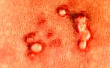 چگونه میشود فهمید که HPV داریم؟

