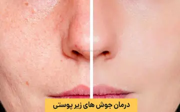 جوش زیر پوستی رو با این روش‌ها از بین ببر! 