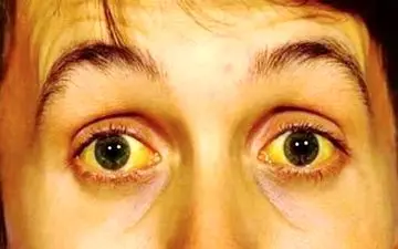 اطلاعاتی درباره بیماری هپاتیت/ اینفوگرافیک