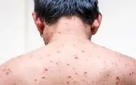 علائم آبله مرغان در بزرگسالی را بشناسید