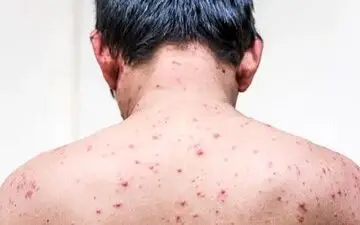 علائم آبله مرغان در بزرگسالی را بشناسید