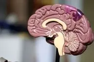 این نشانه ها می گوید سکته مغزی در راه است
