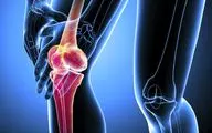 کبودی استخوان+ نشانه ها، دلایل و درمان